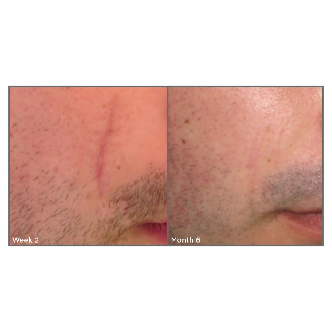 SCAR SPRAY Z360